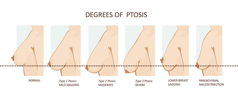 Ptotic Breasts and Surgical Solutions - Phoenix Cosmetic Surgeon