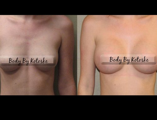 Breast Enlargement Options: Saline vs. Silicone Implants Explained