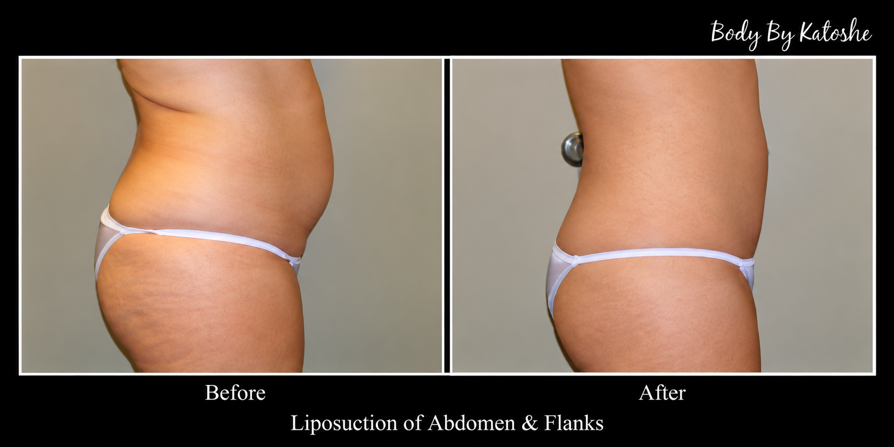 Remove Stubborn Fat